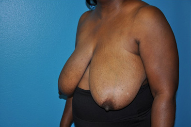 Breast Reduction Case 494 Before Photo Breast Reduction