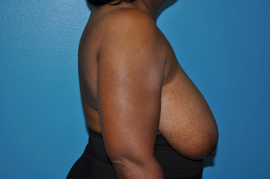 Breast Reduction Case 494 Before Photo Breast Reduction