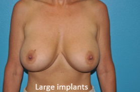 Breast Revisions Case 495 Before Photo Breast Revisions