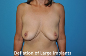 Breast Revisions Case 495 After Photo Breast Revisions