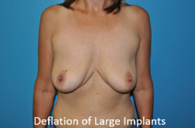 Breast Revisions