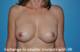 Breast Revisions Case 495 After Photo Breast Revisions