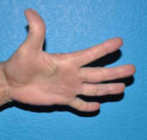 Dupuytren's Contracture