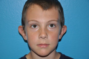 Prominent Ears/Otoplasty Case 504 Before Photo Prominent Ears/Otoplasty