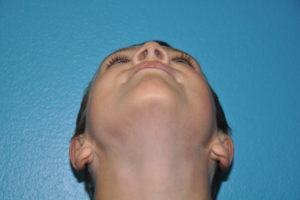 Prominent Ears/Otoplasty Case 504 After Photo Prominent Ears/Otoplasty