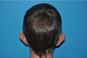 Prominent Ears/Otoplasty Case 504 Before Photo Prominent Ears/Otoplasty
