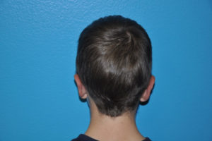 Prominent Ears/Otoplasty Case 504 After Photo Prominent Ears/Otoplasty