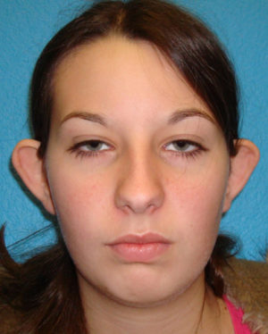 Prominent Ears/Otoplasty Case 506 Before Photo Prominent Ears/Otoplasty
