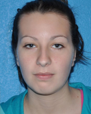 Prominent Ears/Otoplasty Case 506 After Photo Prominent Ears/Otoplasty
