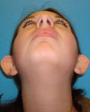 Prominent Ears/Otoplasty Case 506 Before Photo Prominent Ears/Otoplasty