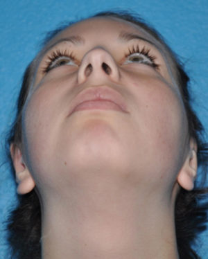 Prominent Ears/Otoplasty Case 506 After Photo Prominent Ears/Otoplasty
