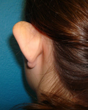 Prominent Ears/Otoplasty Case 506 Before Photo Prominent Ears/Otoplasty