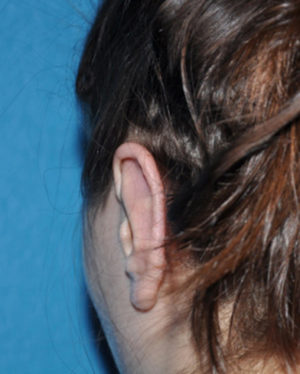Prominent Ears/Otoplasty