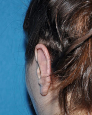 Prominent Ears/Otoplasty Case 506 After Photo Prominent Ears/Otoplasty