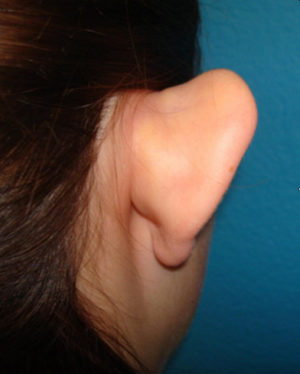 Prominent Ears/Otoplasty Case 506 Before Photo Prominent Ears/Otoplasty
