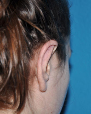 Prominent Ears/Otoplasty Case 506 After Photo Prominent Ears/Otoplasty