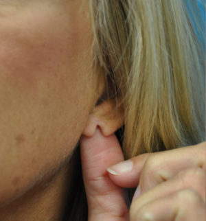 Ear Repair