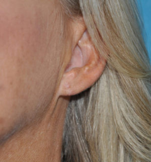 Ear Repair
