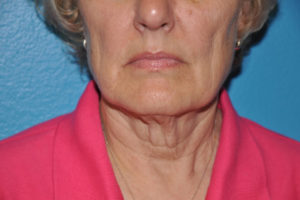 Facelift