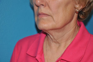 Facelift