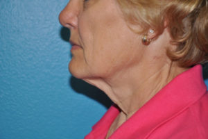 Facelift