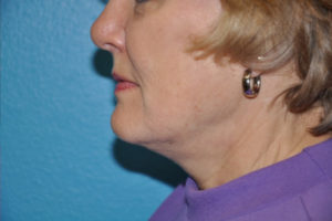 Facelift