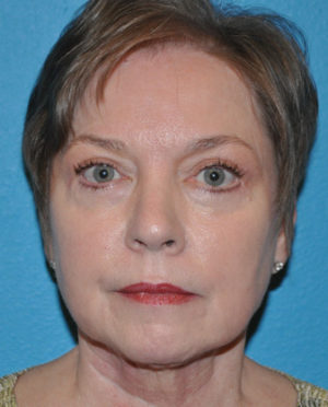 Facelift