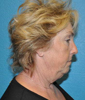 Facelift