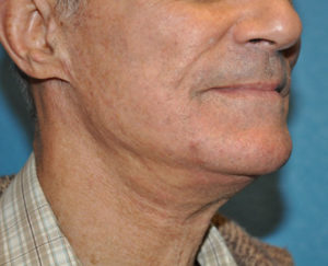 Facelift
