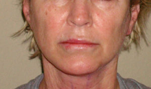 Facelift