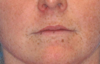 Fillers