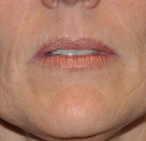 Fillers