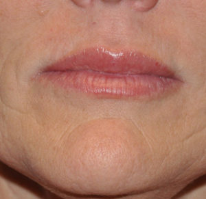 Fillers