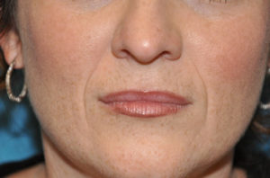 Fillers
