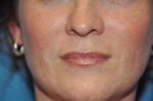 Fillers