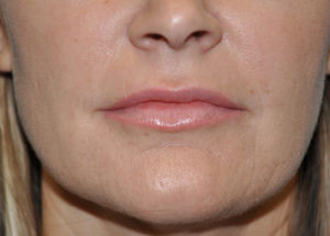 Fillers