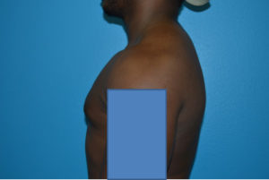 Gynecomastia Case 623 After Photo Gynecomastia