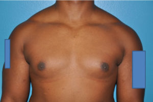 Gynecomastia Case 623 Before Photo Gynecomastia