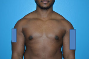 Gynecomastia Case 623 After Photo Gynecomastia