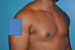 Gynecomastia Case 623 Before Photo Gynecomastia