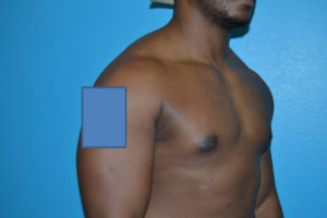 Gynecomastia Case 623 After Photo Gynecomastia
