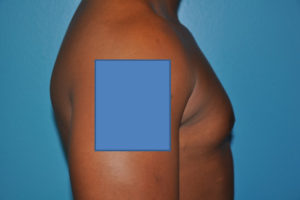 Gynecomastia Case 623 Before Photo Gynecomastia