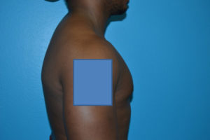 Gynecomastia Case 623 After Photo Gynecomastia