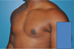 Gynecomastia Case 623 Before Photo Gynecomastia