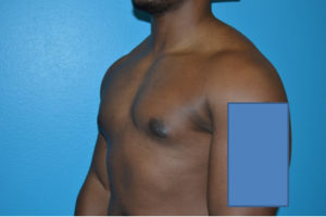 Gynecomastia Case 623 After Photo Gynecomastia