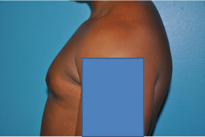 Gynecomastia Case 623 Before Photo Gynecomastia