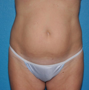 Liposuction Case 624 Before Photo Liposuction