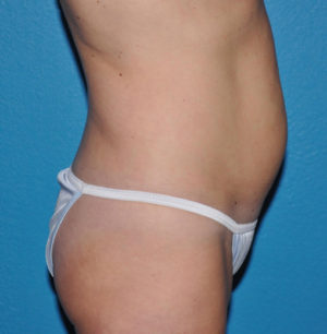 Liposuction Case 624 Before Photo Liposuction