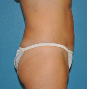 Liposuction Case 624 After Photo Liposuction
