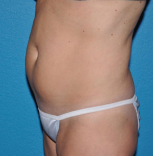 Liposuction Case 624 Before Photo Liposuction